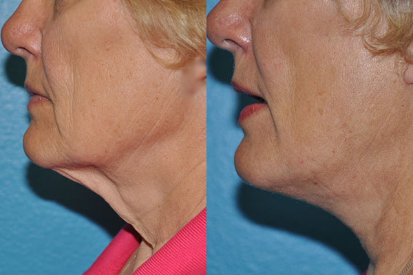 Facelift