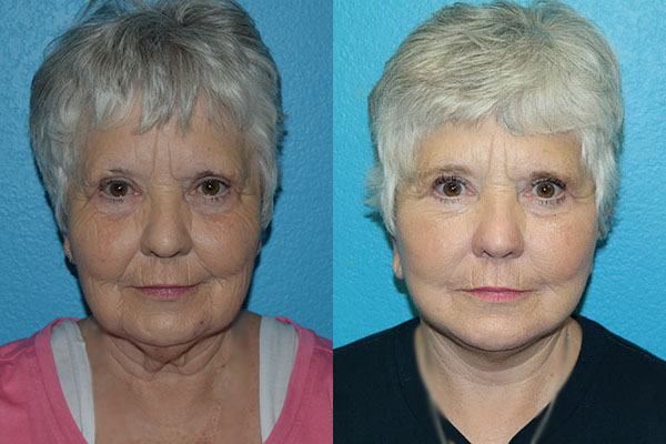 Facelift