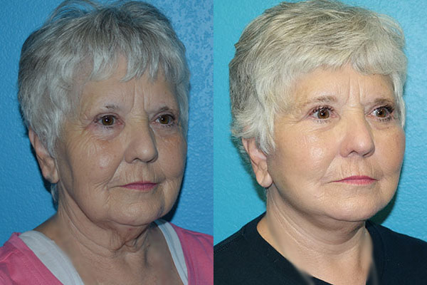 Facelift