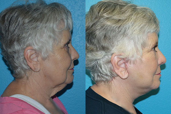 Facelift