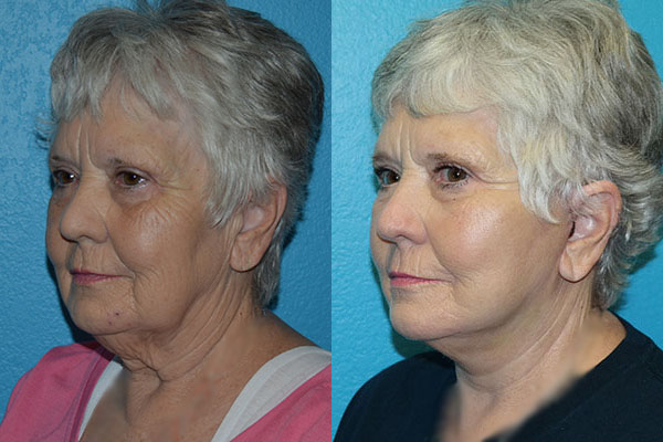 Facelift