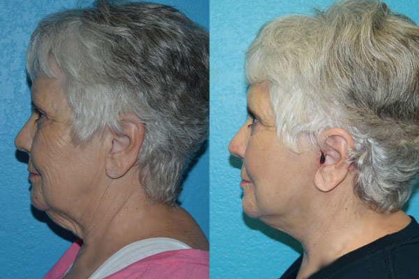 Facelift