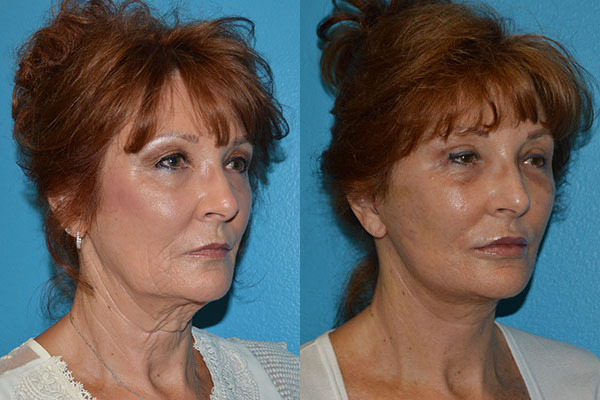 Facelift