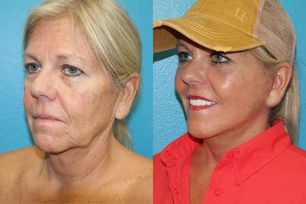 Facelift