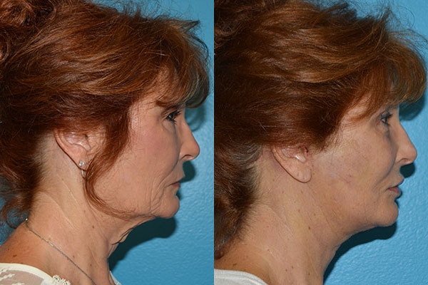 Facelift