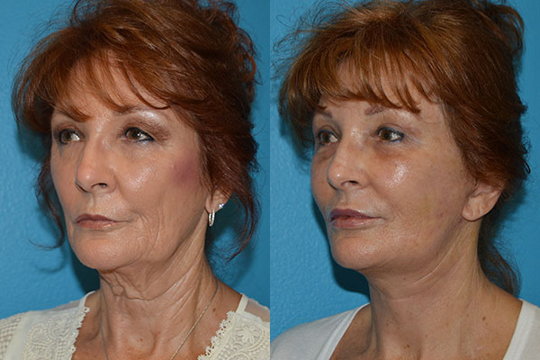 Facelift