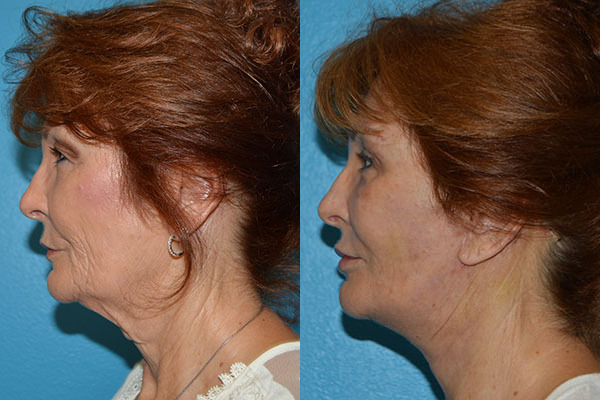 Facelift