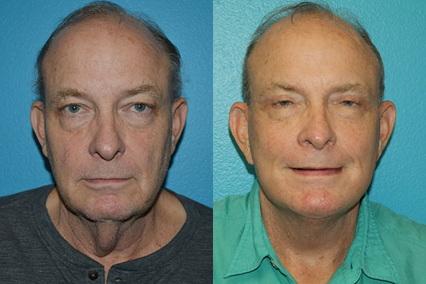 Facelift