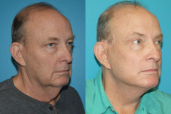 Facelift