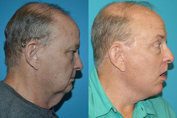 Facelift