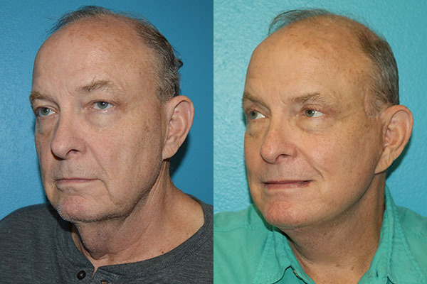 Facelift