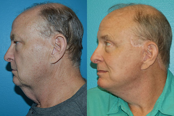 Facelift