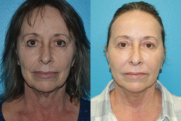 Facelift