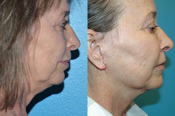 Facelift