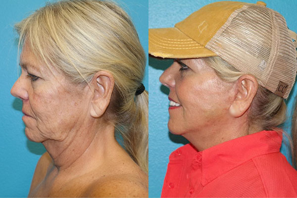 Facelift