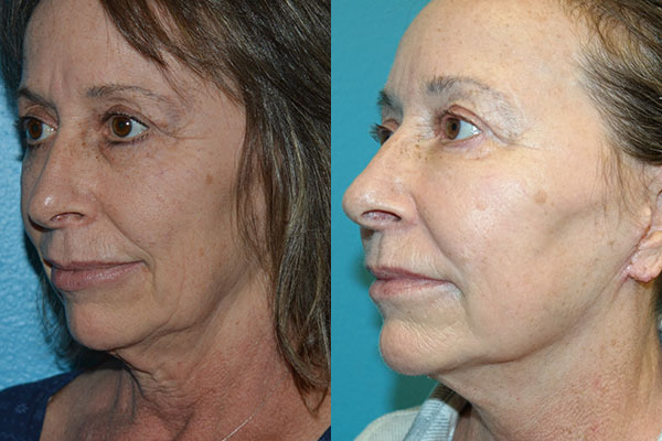 Facelift