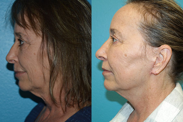 Facelift