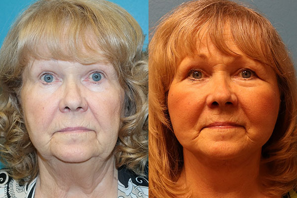 Facelift