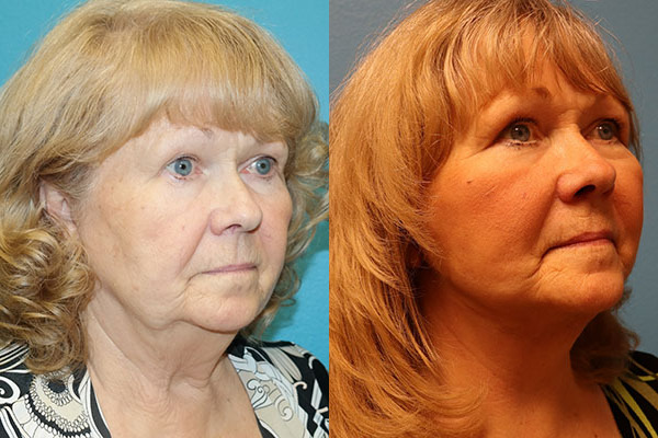 Facelift