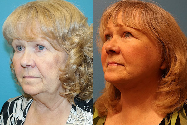 Facelift