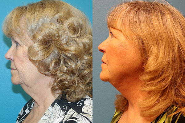 Facelift