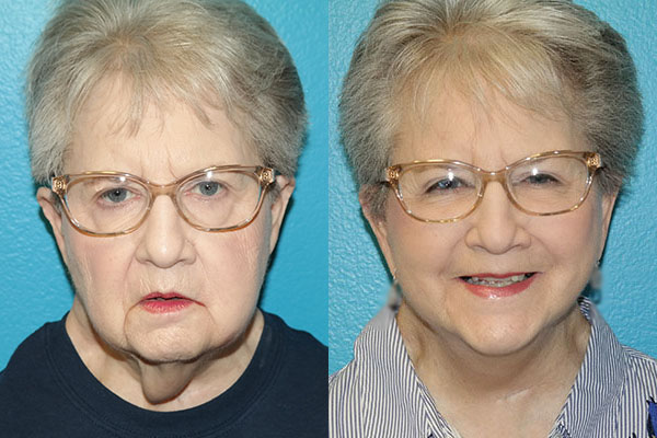 Facelift