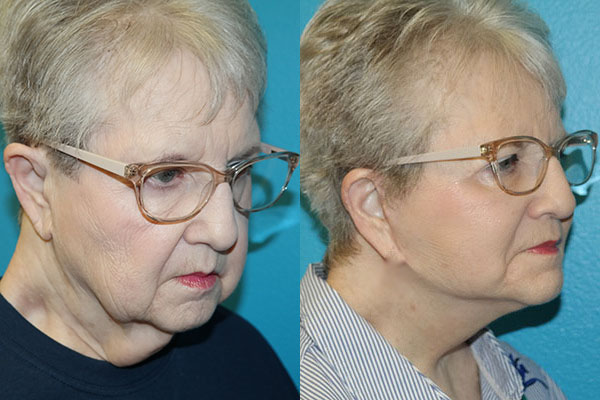Facelift