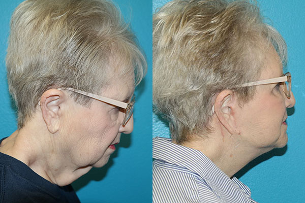Facelift