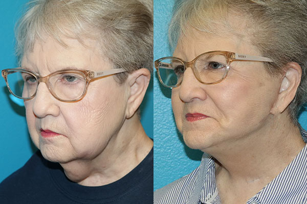 Facelift