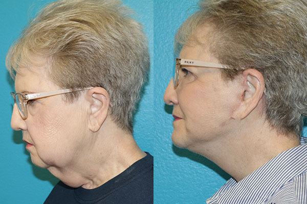 Facelift