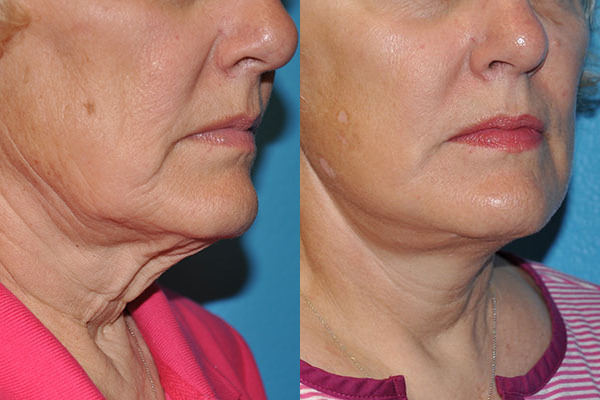 Facelift