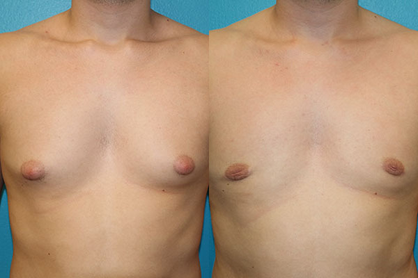 Gynecomastia