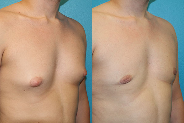 Gynecomastia