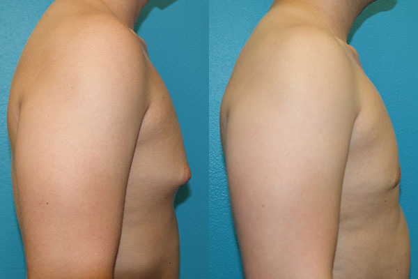 Gynecomastia