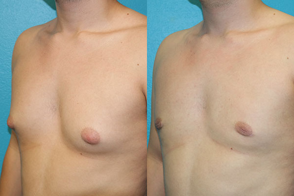 Gynecomastia