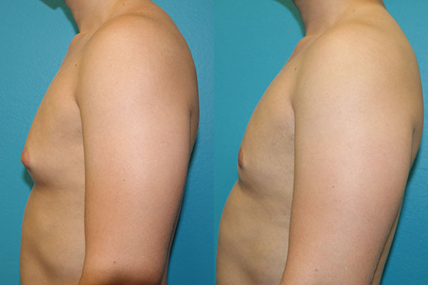 Gynecomastia