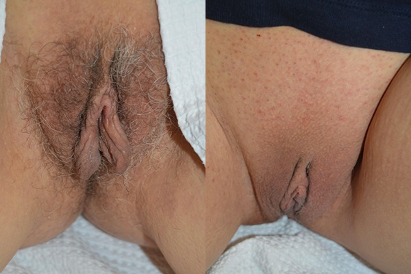Labiaplasty