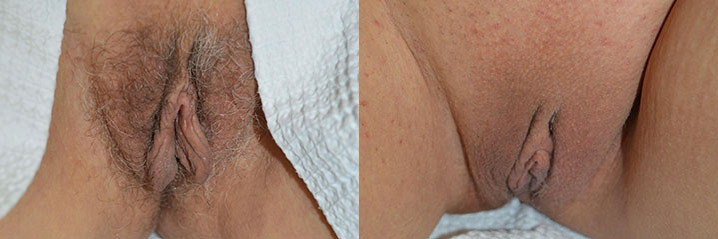 labiaplasty before and after images