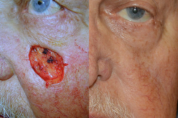 Skin Cancer Reconstruction