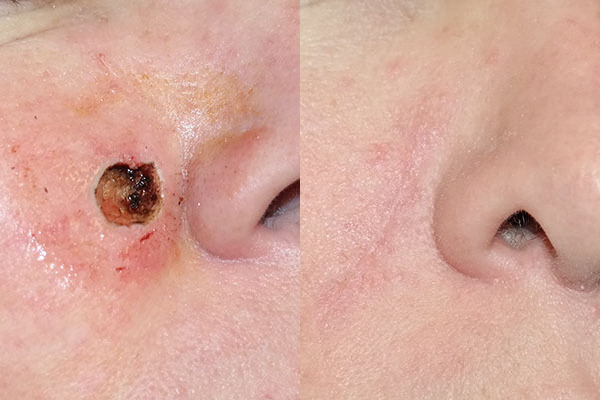Skin Cancer Reconstruction