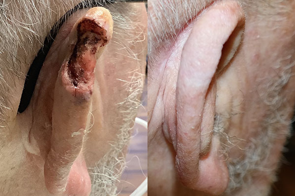 Skin Cancer Reconstruction