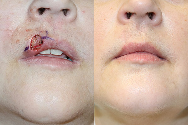 Skin Cancer Reconstruction