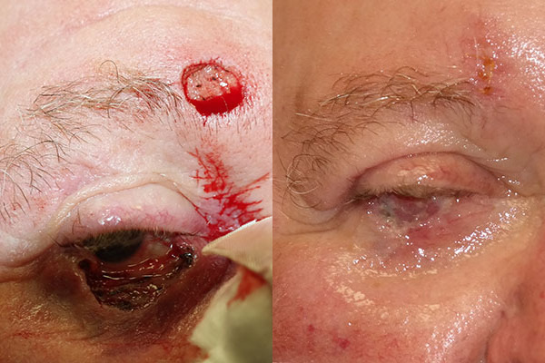 Skin Cancer Reconstruction