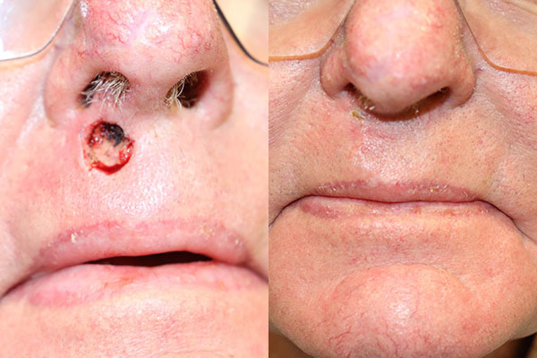 Skin Cancer Reconstruction