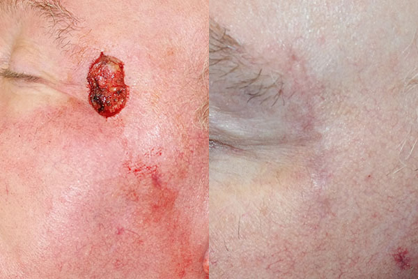 Skin Cancer Reconstruction