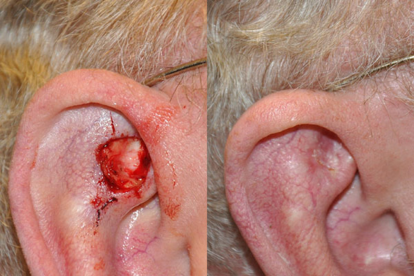 Skin Cancer Reconstruction