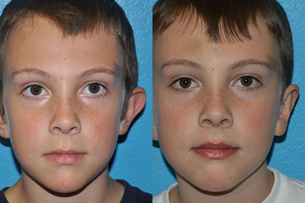 Prominent Ears/Otoplasty