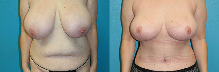 mommy makeover before and after images