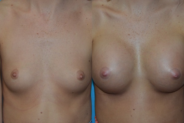Augmentation
