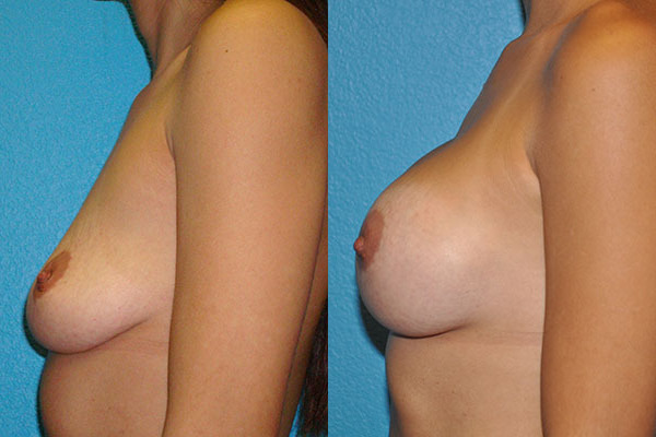Augmentation